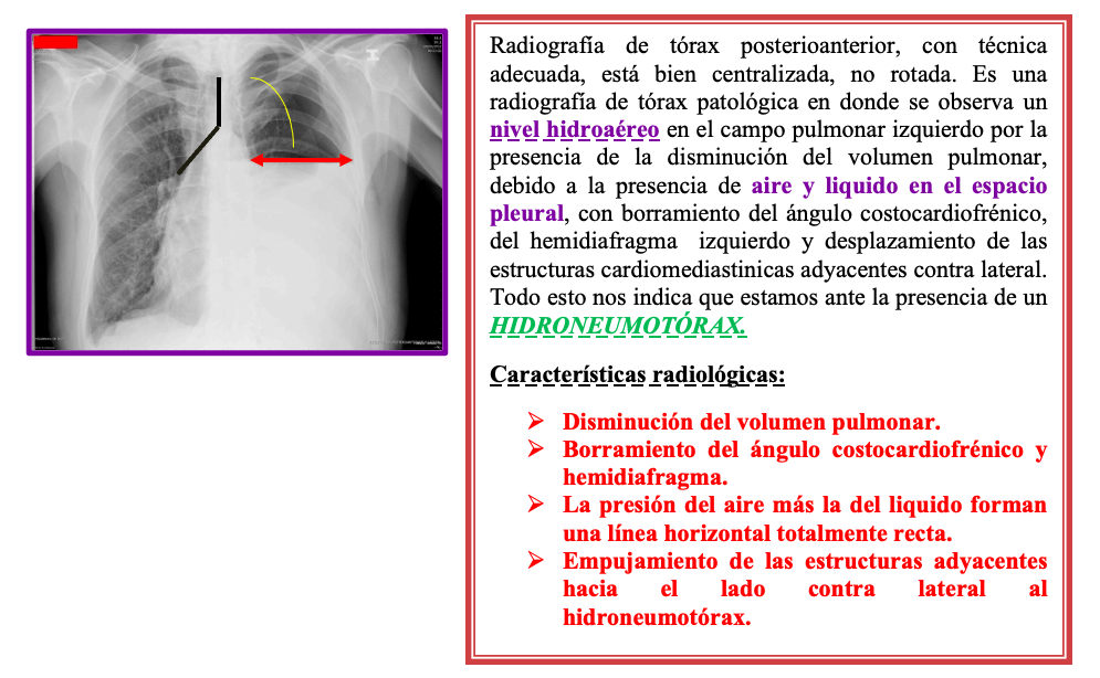 Tórax Patológico: Descripción y diagnostico de Imágenes.
