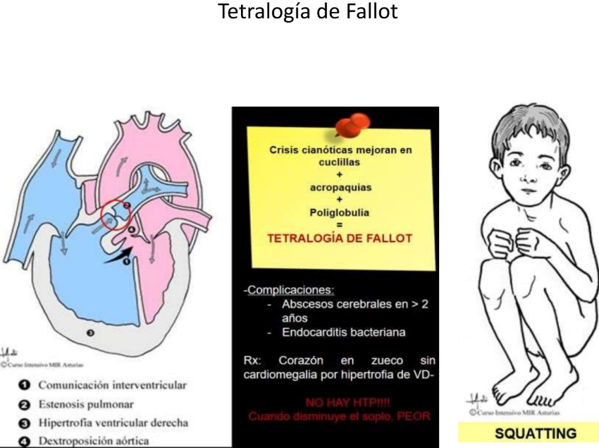 La Tetralogía de Fallot es la cardiopatía congénita cianótica más frecuente después del año de vida. Como su nombre indica, se define por 4 hallazgos clave que podemos ver en esta imagen:

Comunicación Interventricular (CIV): Un orificio entre los ventrículos.

Estenosis Pulmonar: Obstrucción al flujo de salida del ventrículo derecho.

Hipertrofia del Ventrículo Derecho: Por el esfuerzo de bombear contra la obstrucción.

Aorta Cabalgante (Dextroposición): La aorta se desplaza hacia la derecha sobre la CIV.

🔍 ¿Por qué el "Squatting" o Cuclillas?
Es un signo clásico. Al ponerse en cuclillas, el niño aumenta la resistencia vascular sistémica. Esto disminuye el cortocircuito de derecha a izquierda, enviando más sangre a los pulmones para ser oxigenada. ¡Es un mecanismo de defensa instintivo!

💡 Datos clave para el examen (MIR):
Radiografía: El famoso "corazón en sueco" o en bota (por la hipertrofia del VD y la punta levantada).

Ojo con el soplo: ¡Cuidado! Si el soplo disminuye de intensidad durante una crisis, significa que la obstrucción es peor.

Complicaciones: Riesgo elevado de abscesos cerebrales y endocarditis.

#Cardiología #Pediatría #Medicina #TetralogíaDeFallot #EstudianteDeMedicina #RepasoMédico