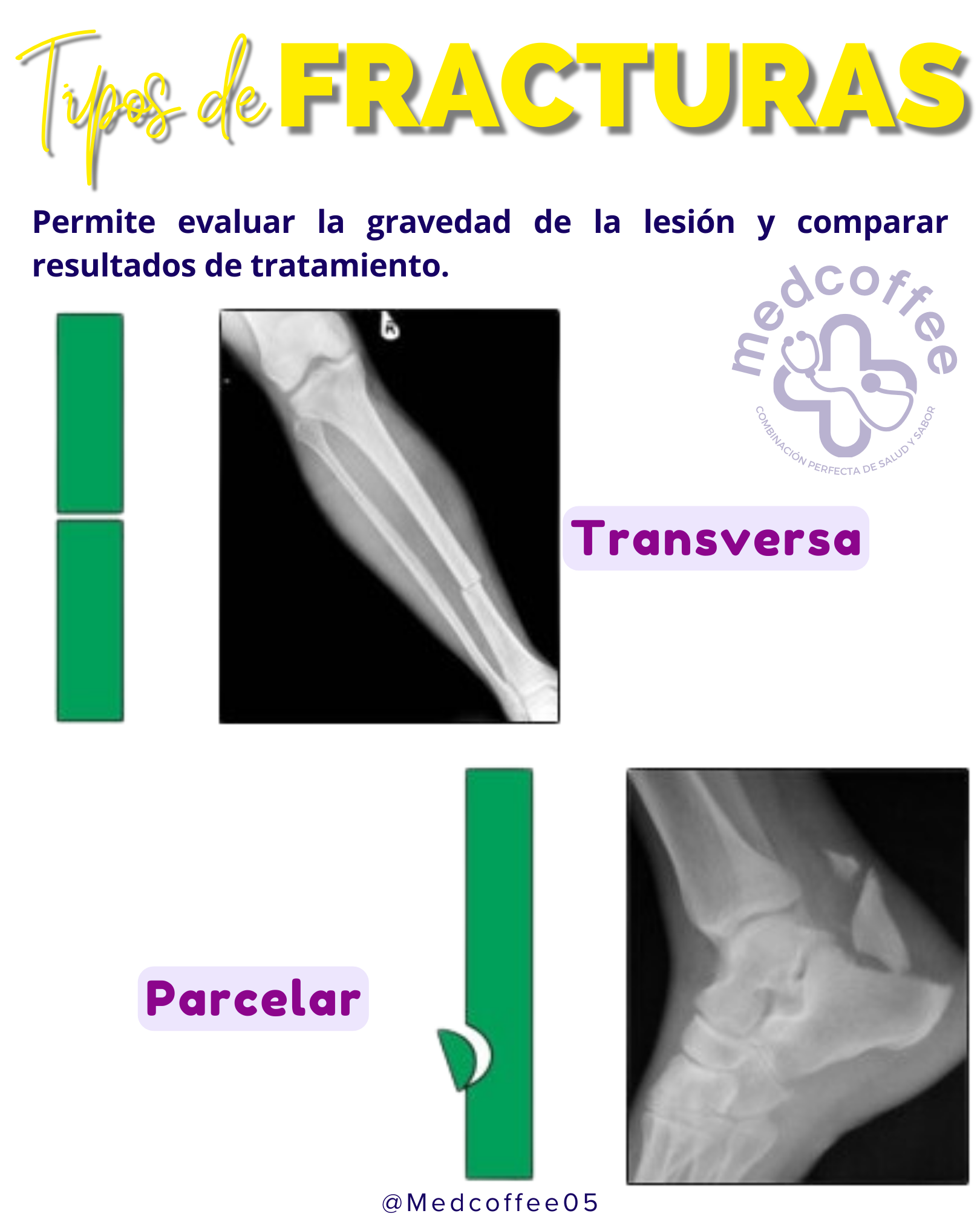 TIPOS DE FRACTURAS