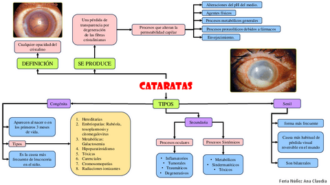 Apuntes de oftalmología:Catarata,retinopatia diabetica,toxocariasis y toxoplasmosis.pdf