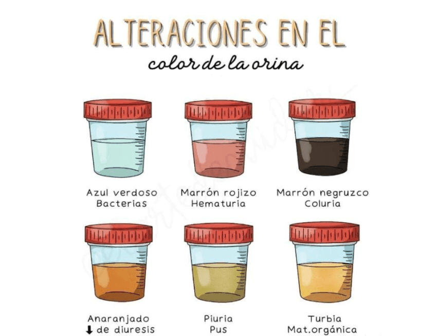 Alteraciones-en-el-color-de-la-orina.pdf
