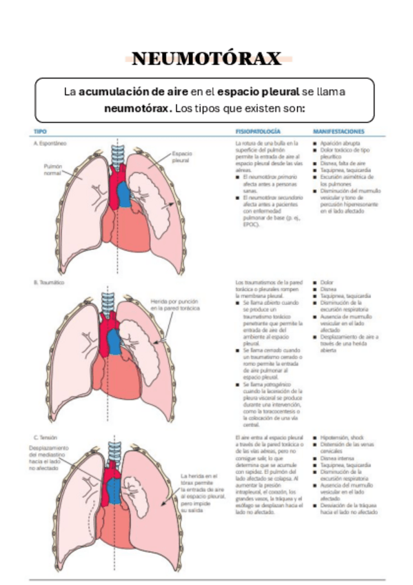 Neumotorax-NURSE-CARDS.pdf