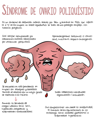 Sindrome-de-ovario-poliquistico.pdf