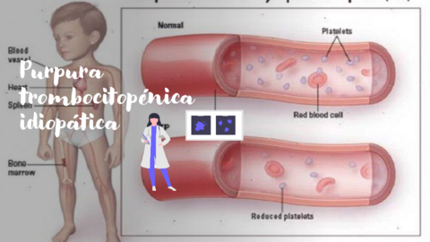 PURPURA-TROMBOCITOPENICA-IDIOPATICA.pdf