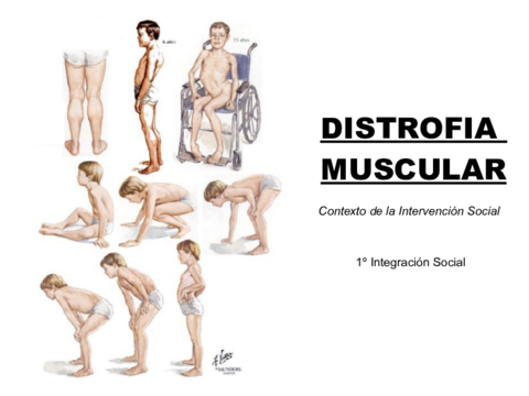 Power-point-Distrofia-muscular.pdf