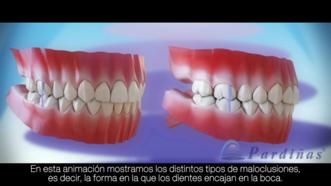 Maloclusion-Tipos-de-maloclusiones-dentales-c.mp4