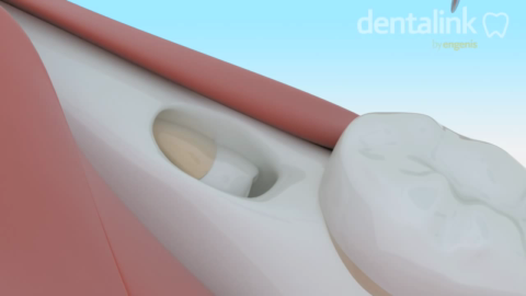 Exodoncia-compleja-tercer-molar-incluido-EXPLICACION-A-PACIENTES-Dentalink-Software-Dental.mp4