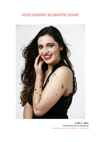 NEVUS-CONGENIT-MELANOCITIC-GEGANT-.pdf