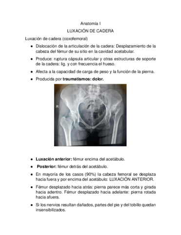 Luxacion-de-cadera-.pdf