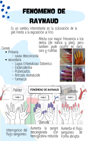 Fenomeno-de-raynaud.pdf