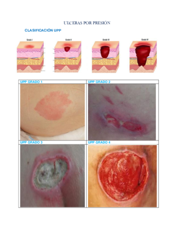 ULCERAS-POR-PRESIONIMAGENES.pdf