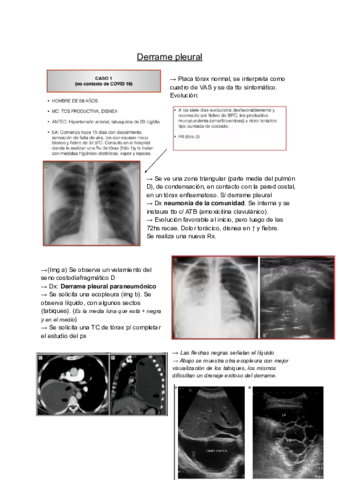 Derrame-pleural-.pdf