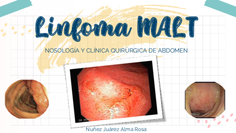 LINFOMA-MALT-ABDOMEN.pdf