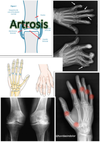 Artrocis.pdf
