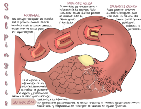 Salpingitis.pdf