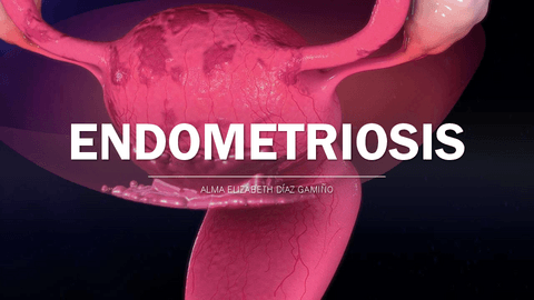 endometriosis-.pdf
