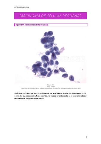 CARCINOMA-DE-CELULAS-PEQUENAS.pdf