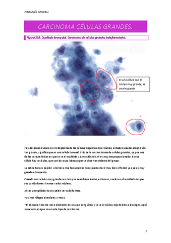 CARCINOMA-CELULAS-GRANDES.pdf
