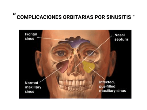 LA-SINUSITIS.pdf
