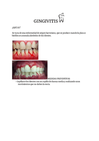 GINGIVITIS-1-1.pdf