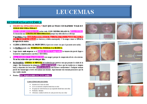 LEUCEMIA.pdf