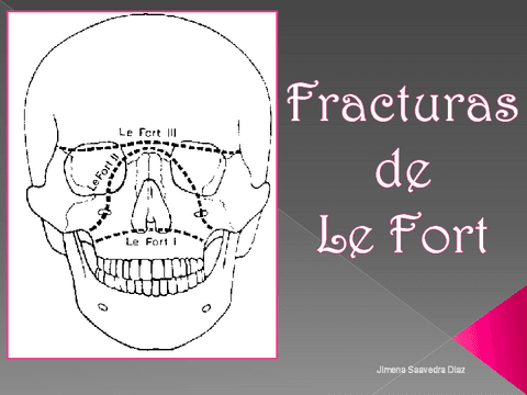 FRACTURAS-DE-LEFORT-1.pdf