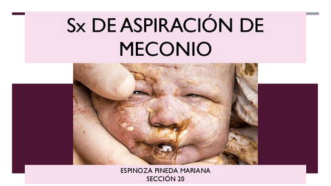 Sx-de-aspiracion-de-Meconio.pdf