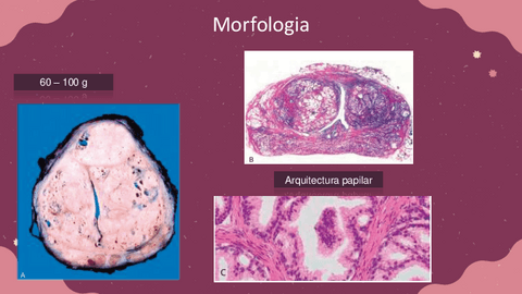 HPB-y-Adenocarcinoma.pdf