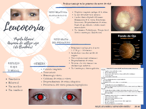 Leucocoria-Retinoblastoma.pdf