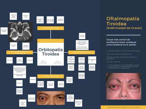 Enfermedad-de-Graves-Oftalmopatia-Tiroidea.pdf