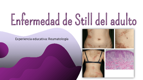 Enfermedad-Still-del-adulto.pdf