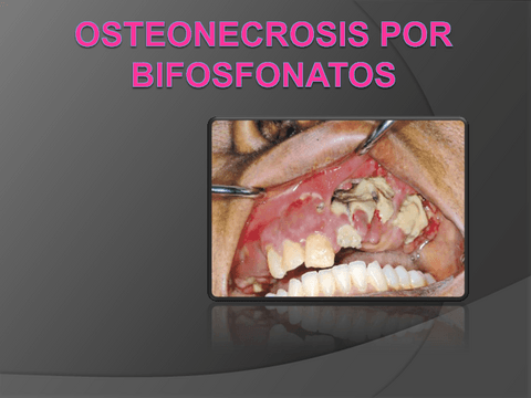 semi-bifosfonatos22.pdf