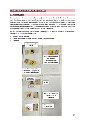 2. Tuberculosis y apendicitis.pdf