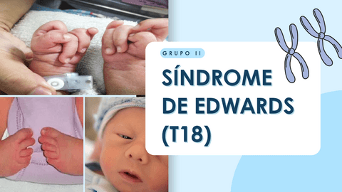 Sindrome-de-Edwars.pdf