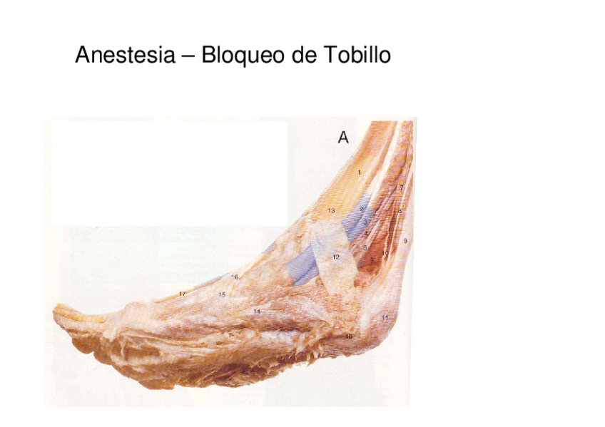 Miniatura del documento Tema-1.2-Anestesia-bloqueo-del-tobillo.pdf