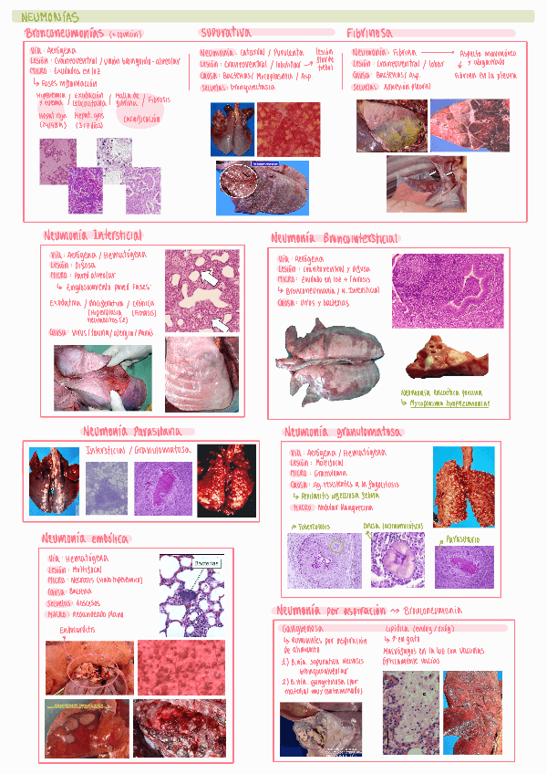 Miniatura del documento Resumen-Neumonias.pdf