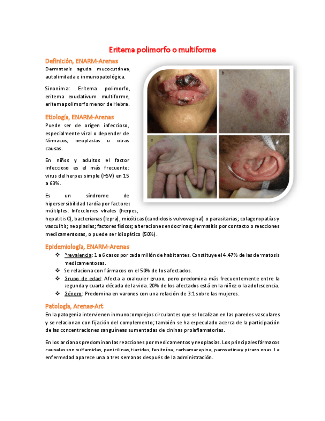 Miniatura del documento 4-Eritema-polimorfo-o-multiforme.pdf