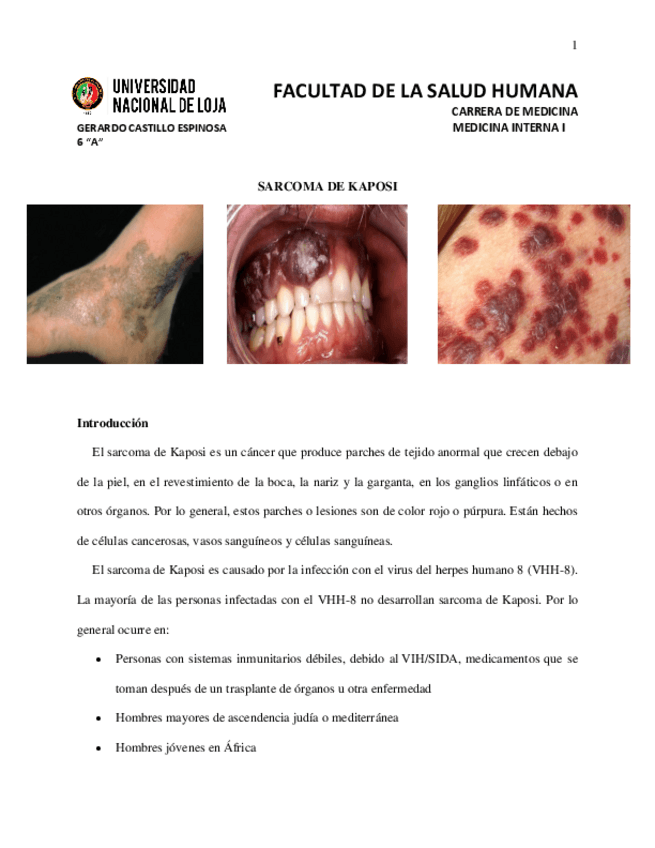 Miniatura del documento Sarcoma-de-Kaposi.pdf