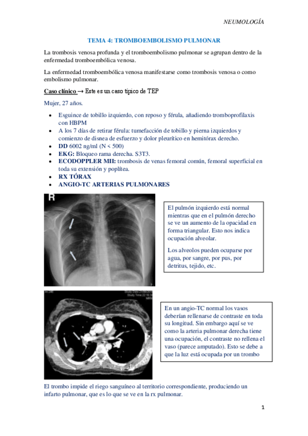 Miniatura del documento T4-Tromboembolismo-pulmonar-TEP.pdf